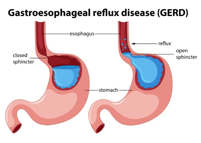 penyebab gerd kambuh
