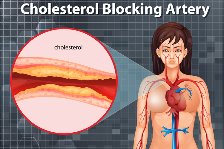 tanda kolesterol tinggi